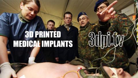 Patient Specific 3D Printed Medical Implants