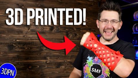 3D Printing and BROKEN BONES?