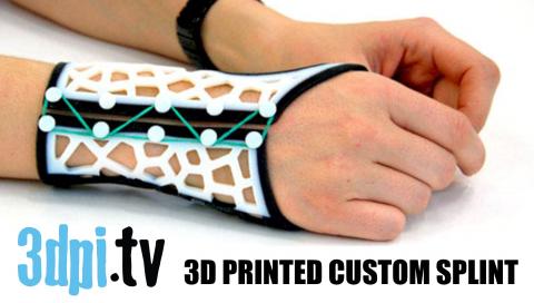 3D Printed Custom Splints