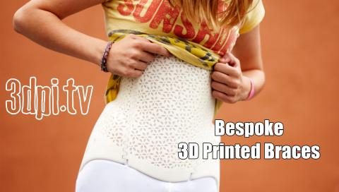 Bespoke 3D Printed Braces for Chronic Scoliosis