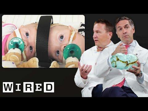 Surgeons Break Down Separating Conjoined Twins | WIRED